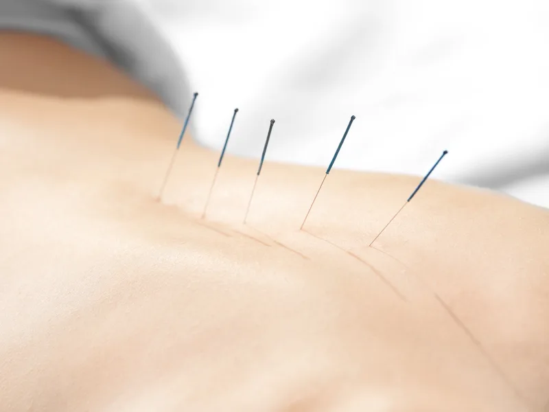 Acupuncture at Rise Family Chiropractic in Hudsonville