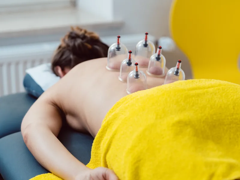 Cupping Therapy at Rise Family Chiropractic in Hudsonville