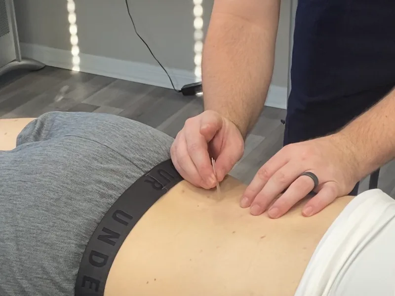 How Dry Needling works at Rise Family Chiropractic
