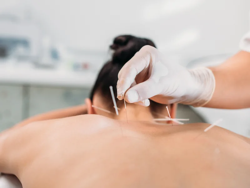 Dry Needling at Rise Family Chiropractic in Hudsonville